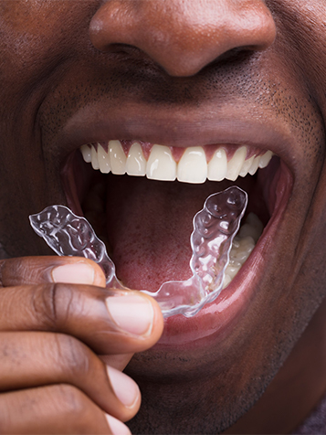 invisalign testimonials